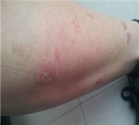 银屑病病人饮食注意什么