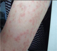 西安哪里可以治疗牛皮癣