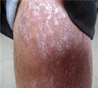 牛皮癣产生的原因都有哪些呢