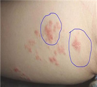 牛皮癣患者的护理措施有哪些