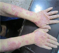 预防牛皮癣的方法有哪些呢