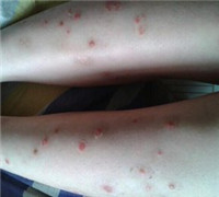 老年牛皮癣怎么治疗