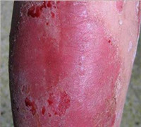 早期的牛皮癣是什么症状